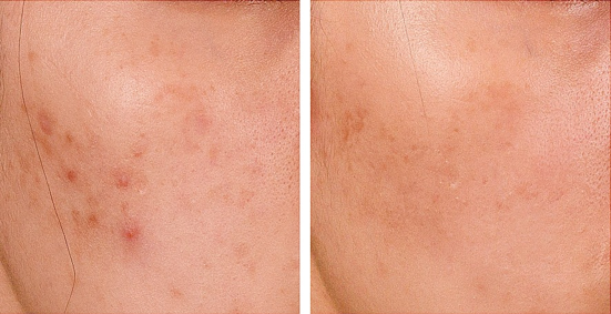 各類痘疤與凹洞