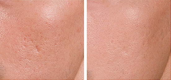 毛孔粗大與粗糙紋理