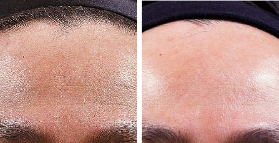 淺層細紋與初老鬆弛